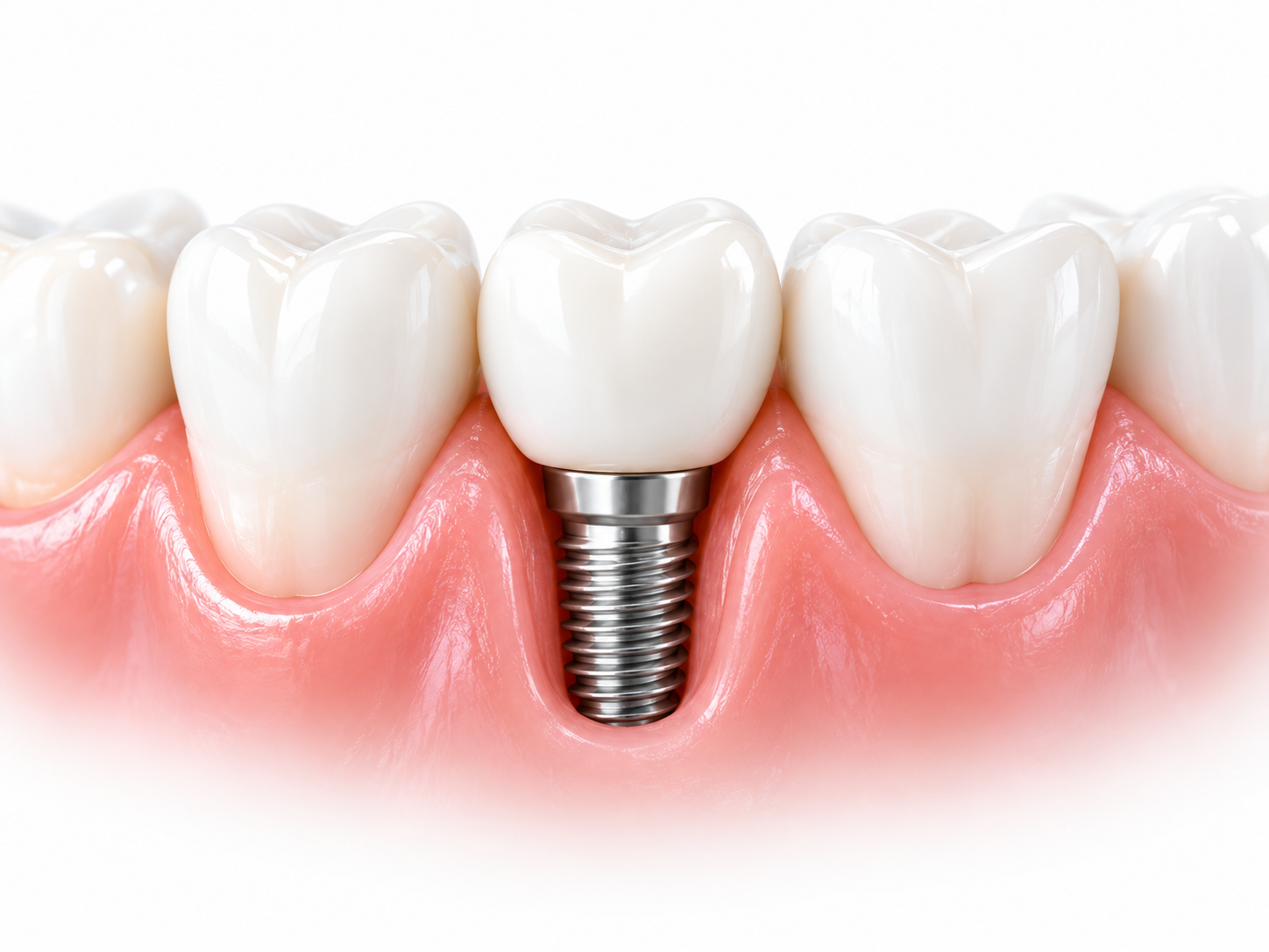 Einzelzahn-Implantat zwischen natürlichen Zähnen