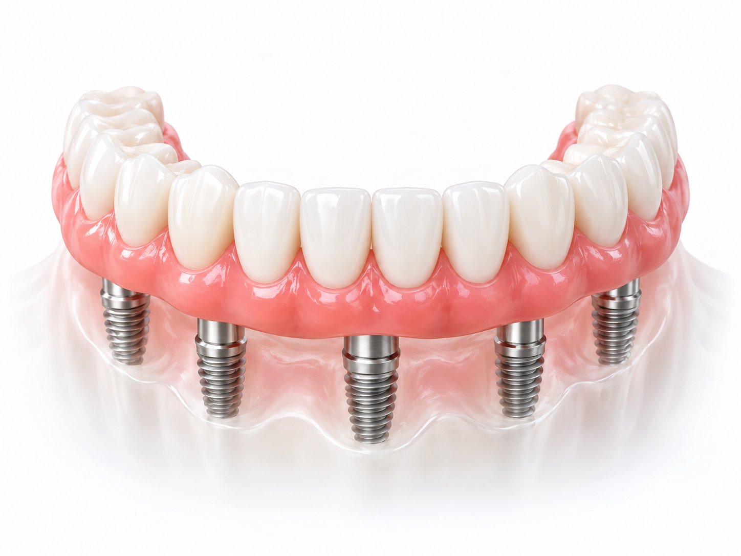 Festsitzender Zahnersatz auf Implantaten