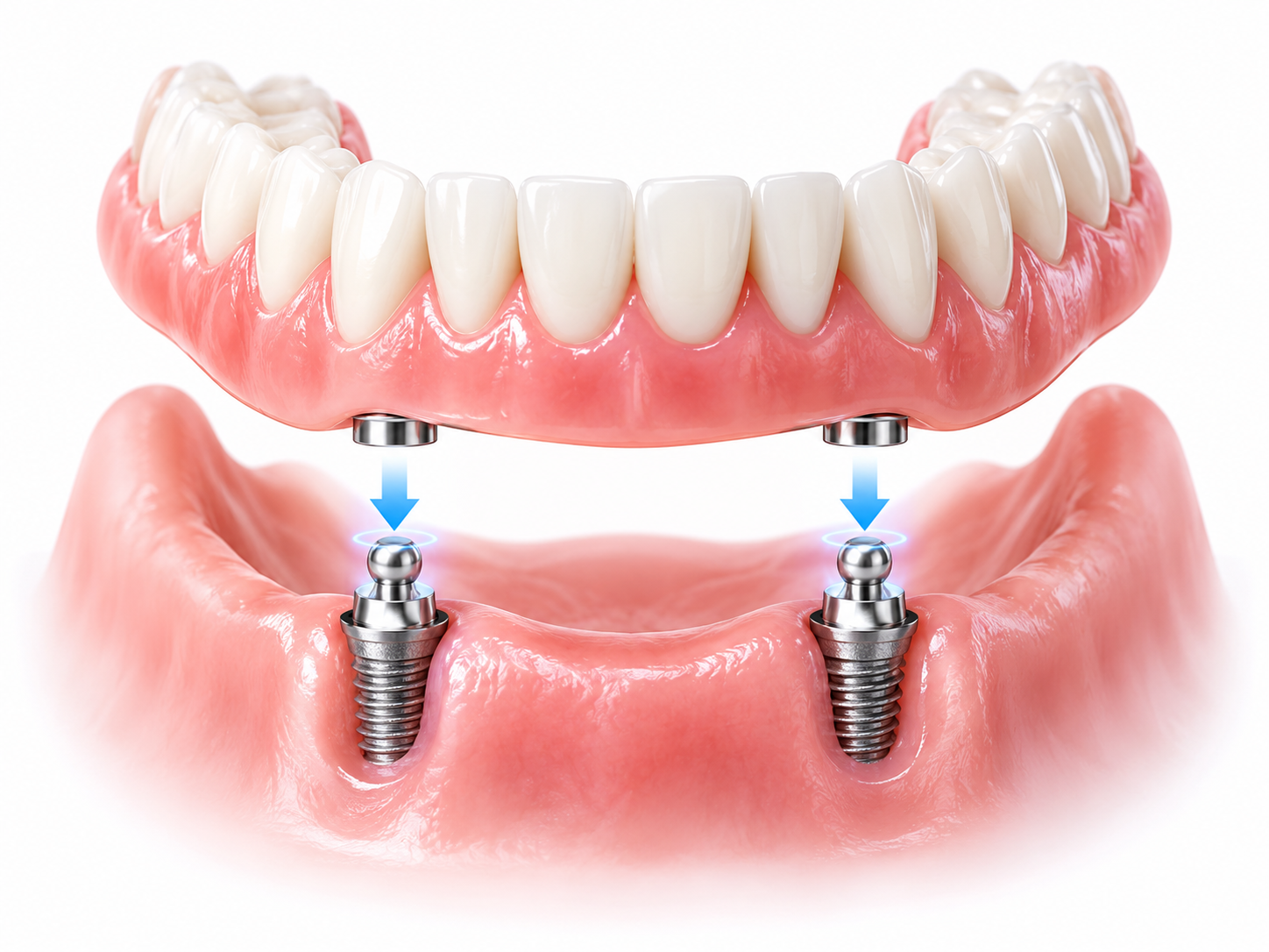 Lockere Prothese wird mit Implantaten stabilisiert